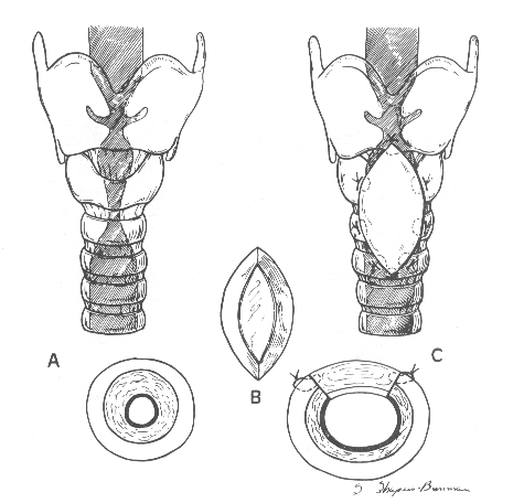 LTR